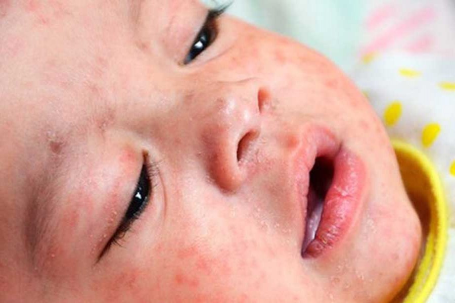 Sporadic outbreaks of vaccine-preventable diseases in parts of BD, says UNICEF