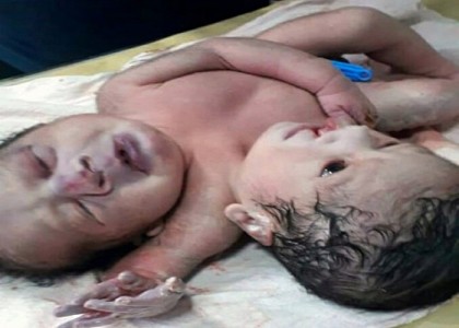 Baby born with two heads in Magura