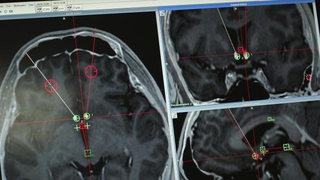 Chinese researchers try brain implants to treat drug addicts 