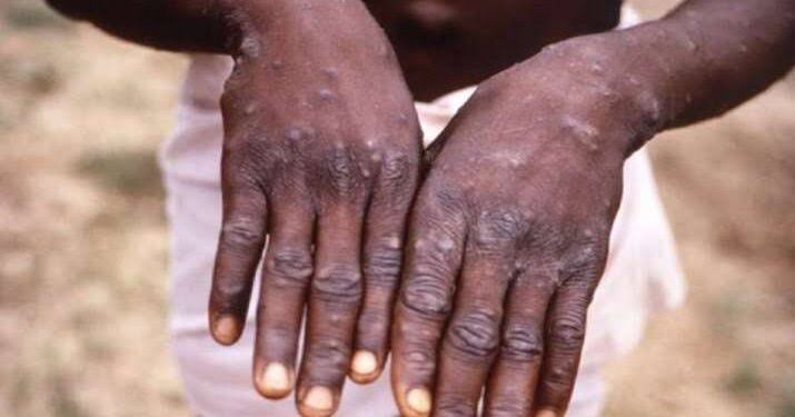 India reports first case of monkeypox